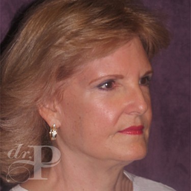 Case--30061 | After Facelift and Neck Lift 4