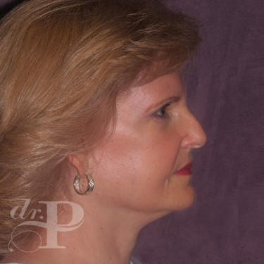 Case--30061 | After Facelift and Neck Lift 5