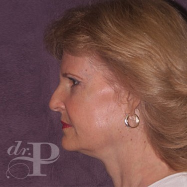 Case--30025 | After Eyelid Surgery (Blepharoplasty) 3