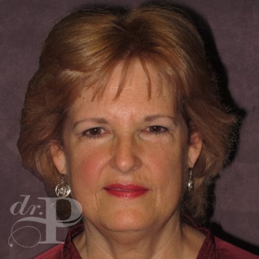 Case--30061 | Before Facelift and Neck Lift 1