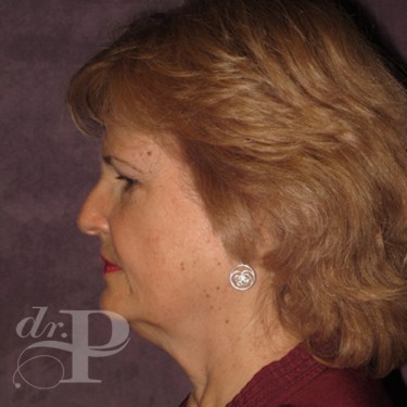 Case--30061 | Before Facelift and Neck Lift 3