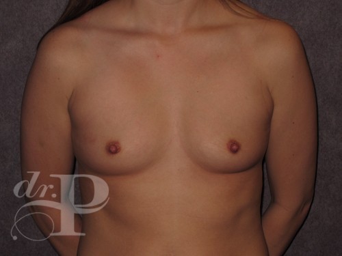 Case--30545 | Before Breast Augmentation 1