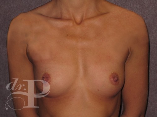 Case--30377 | Before Breast Augmentation 1