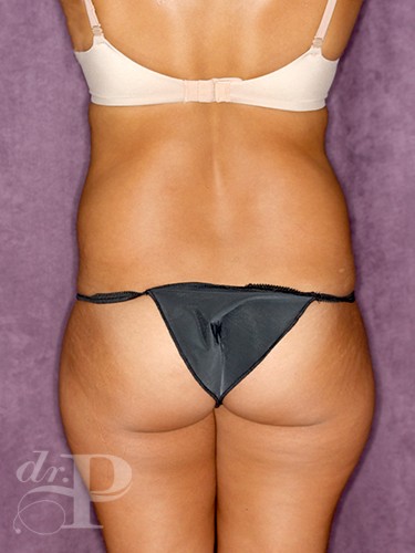 Case--590 | Before Liposuction 4