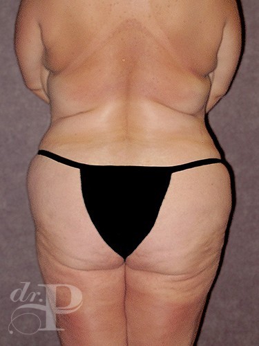 Case--30445 | Before True Form Tummy Tuck® in Overweight & Weight Loss Patients 4