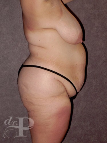 Case--30445 | Before True Form Tummy Tuck® in Overweight & Weight Loss Patients 3