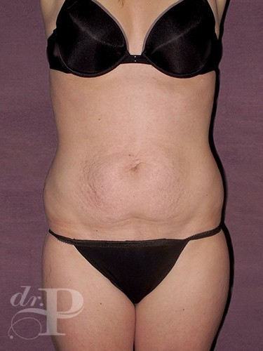Case--1046 | Before Liposuction 1