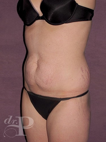 Case--1046 | Before Liposuction 2