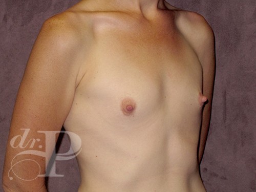Case--28519 | Before Breast Augmentation 3