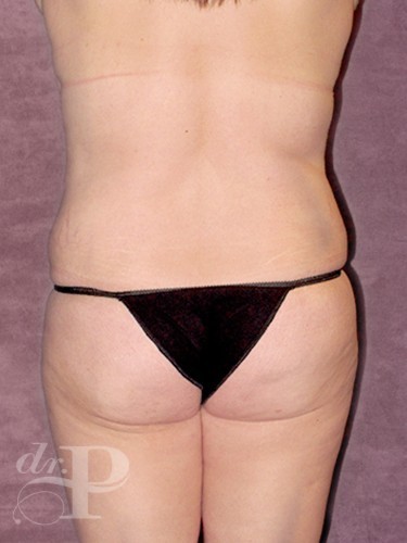 Case--29883 | Before Lower Body Lift (Buttock Lift) 4