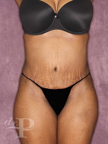 Case--713 | After Liposuction 1