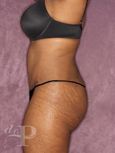Case--713 | After Liposuction 3