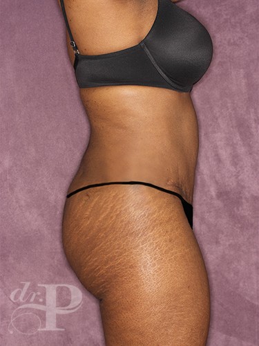 Case--713 | After Liposuction 5