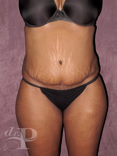 Case--713 | Before Liposuction 1