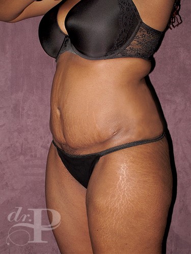 Case--713 | Before Liposuction 2