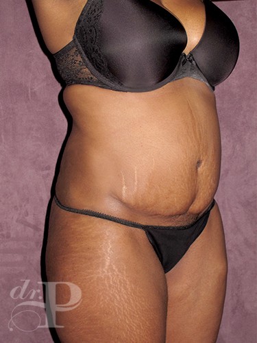 Case--713 | Before Liposuction 4