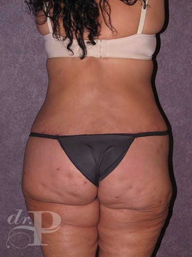 Case--30276 | After True Form Tummy Tuck® in Overweight & Weight Loss Patients 4