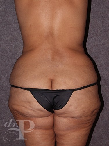 Case--30276 | Before True Form Tummy Tuck® in Overweight & Weight Loss Patients 4