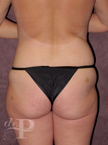 Case--741 | Before True Form Tummy Tuck® 4