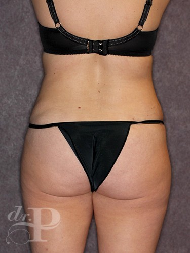 Case--743 | After Liposuction 4