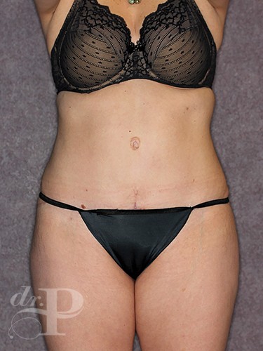 Case--743 | After Liposuction 1
