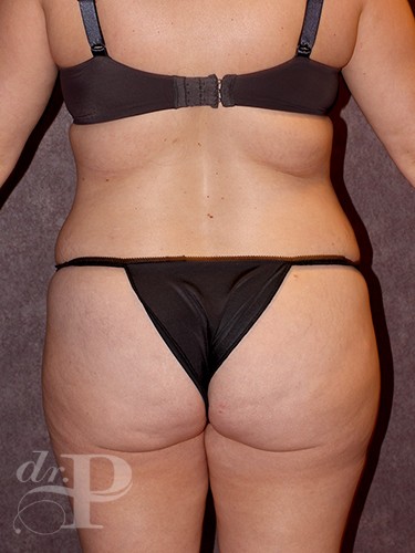 Case--743 | Before Liposuction 4