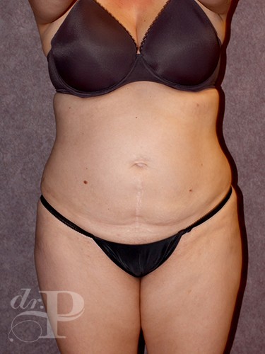 Case--743 | Before Liposuction 1