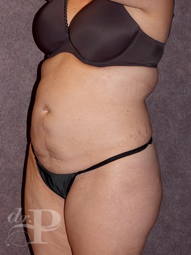 Case--743 | Before Liposuction 2