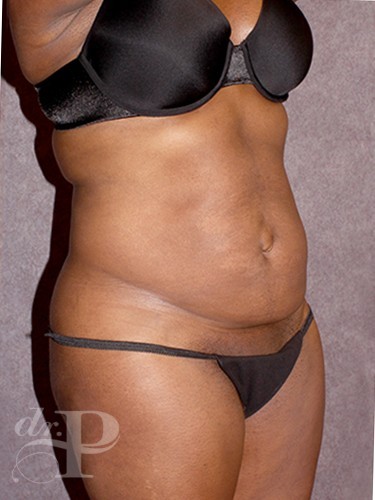 Case--1547 | Before True Form Tummy Tuck® 2