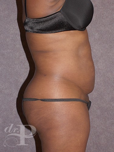 Case--1547 | Before True Form Tummy Tuck® 3