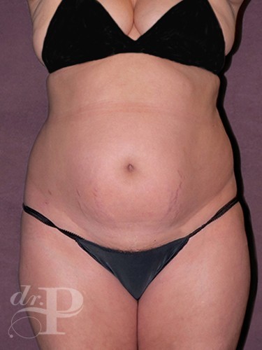 Case--1175 | Before True Form Tummy Tuck® 1
