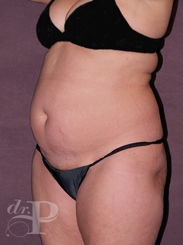 Case--1163 | Before Liposuction 2