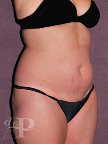 Case--1163 | Before Liposuction 4