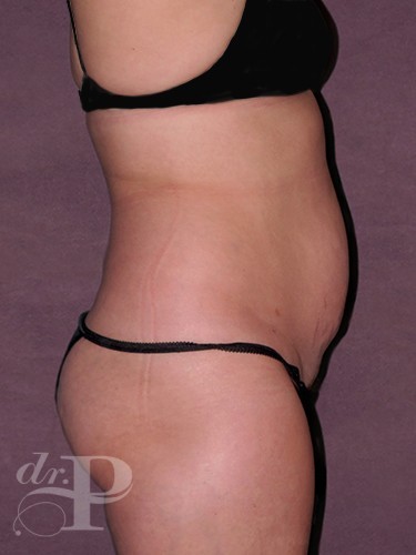 Case--1175 | Before True Form Tummy Tuck® 5