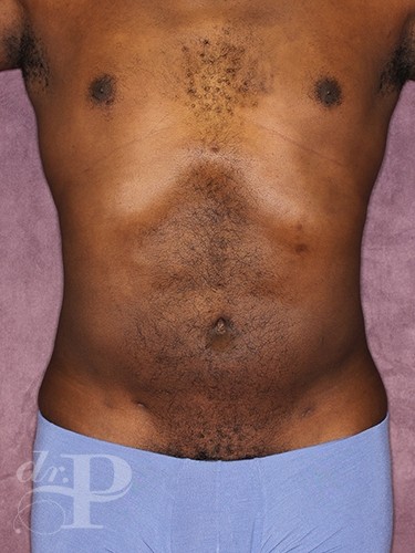 Case--52 | After Liposuction for Men 1