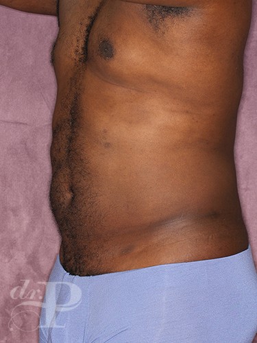 Case--52 | After Liposuction for Men 2