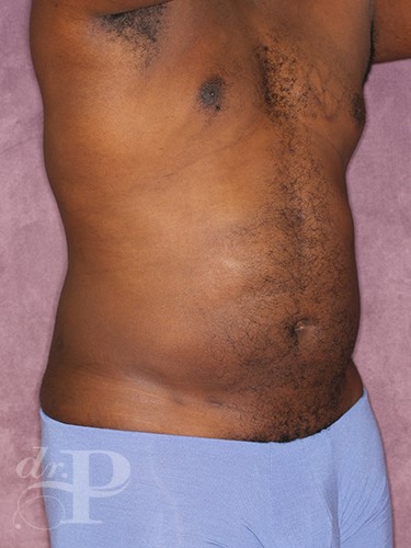 Case--52 | After Liposuction for Men 5
