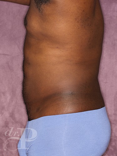 Case--52 | After Liposuction for Men 3