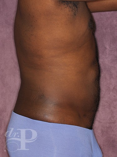 Case--52 | After Liposuction for Men 6