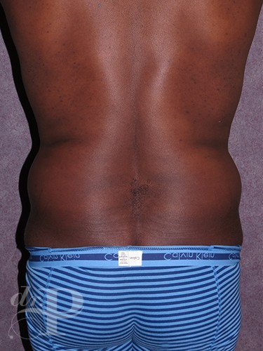 Case--52 | Before Liposuction for Men 4