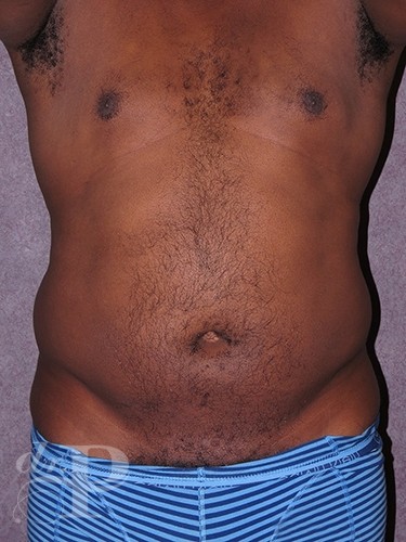 Case--52 | Before Liposuction for Men 1