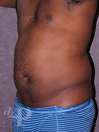 Case--52 | Before Liposuction for Men 2