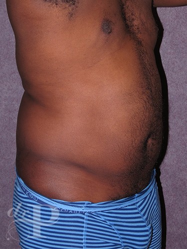 Case--52 | Before Liposuction for Men 5