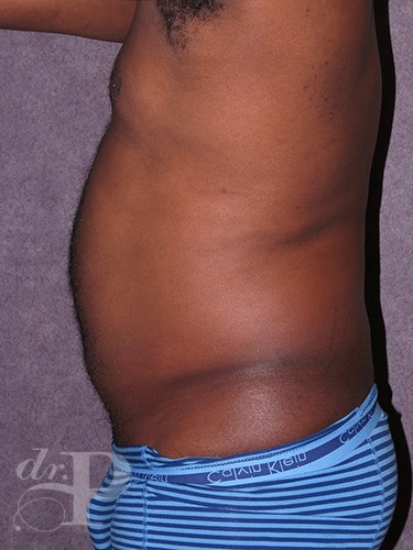 Case--52 | Before Liposuction for Men 3