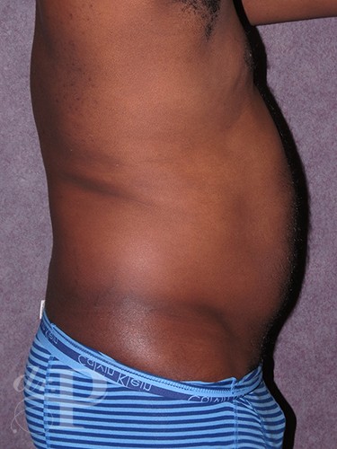 Case--52 | Before Liposuction for Men 6