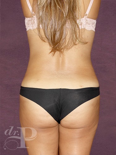 Case--232 | After Liposuction 4