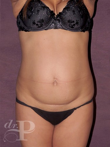 Case--232 | Before Liposuction 1