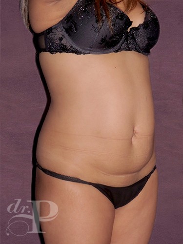 Case--232 | Before Liposuction 5