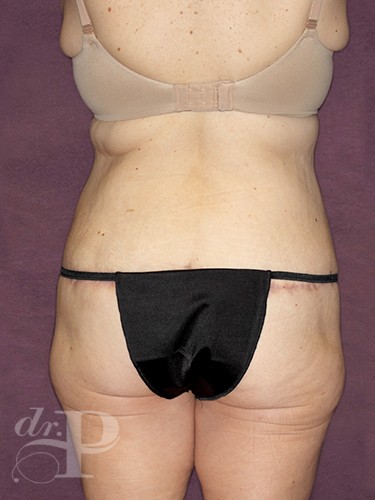 Case--881 | After Liposuction 4