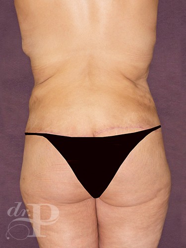 Case--29112 | After Lower Body Lift (Buttock Lift) 4